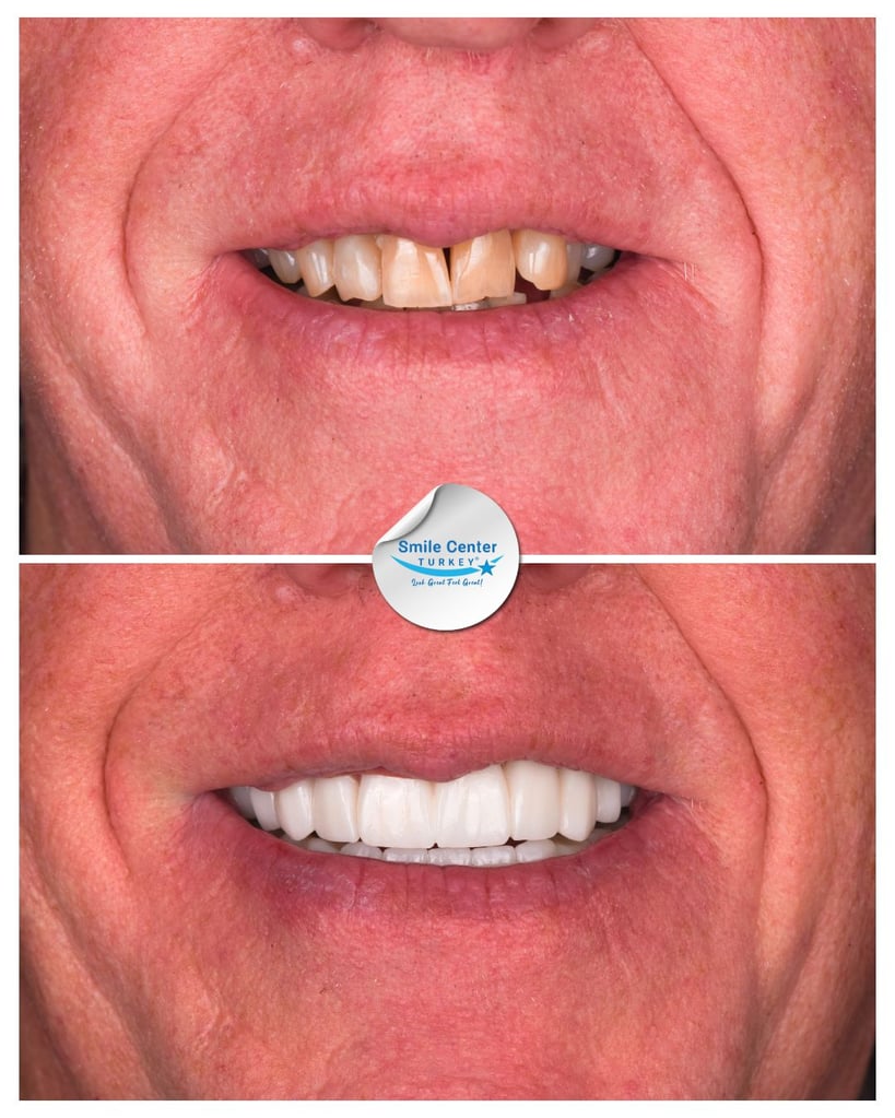 Before and after close-up of a man's smile showing crooked, yellow teeth before treatment and straight, white teeth after dental restoration at Smile Center Turkey.