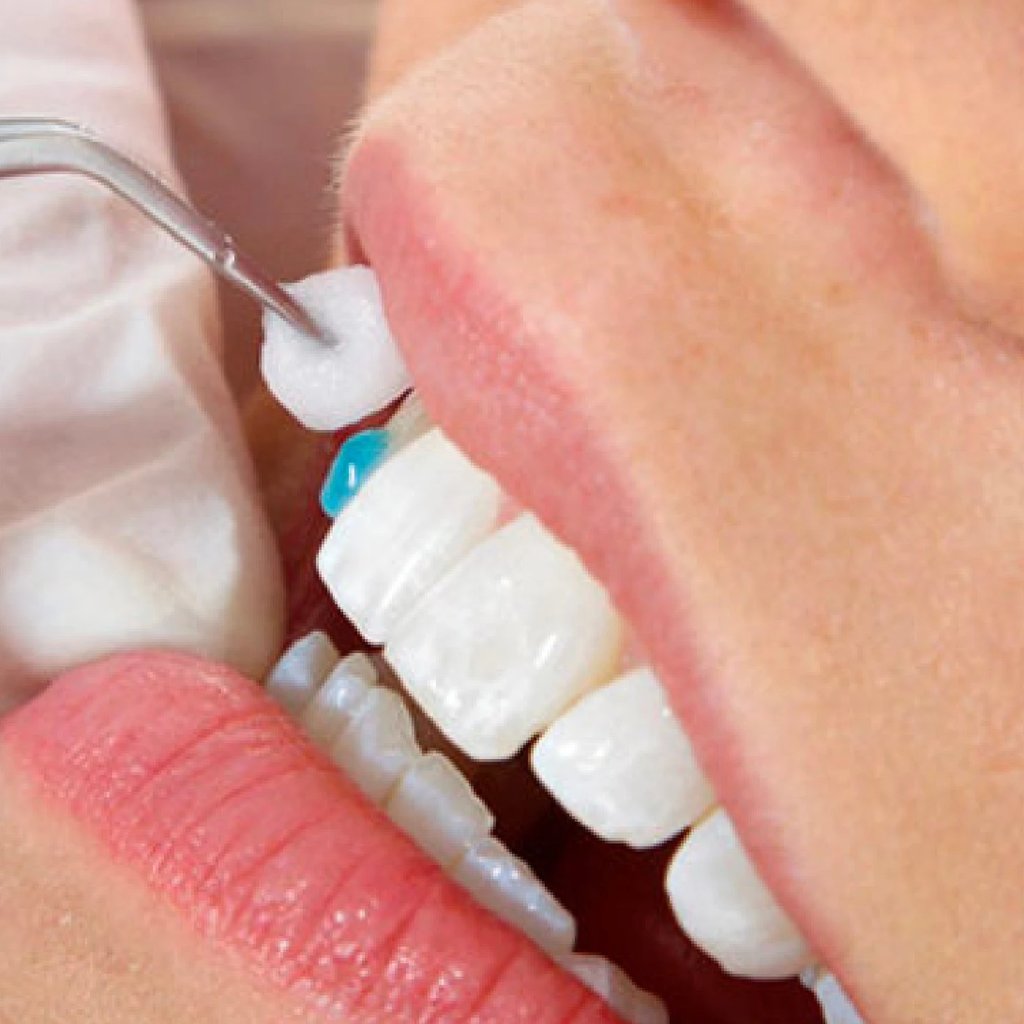 Before and after cosmetic surgery at Smile Center Turkey