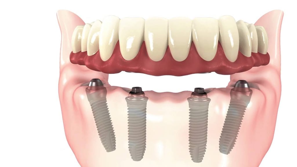 Simplified 3D illustration of all-on-4 dental implants supporting a full upper prosthetic arch