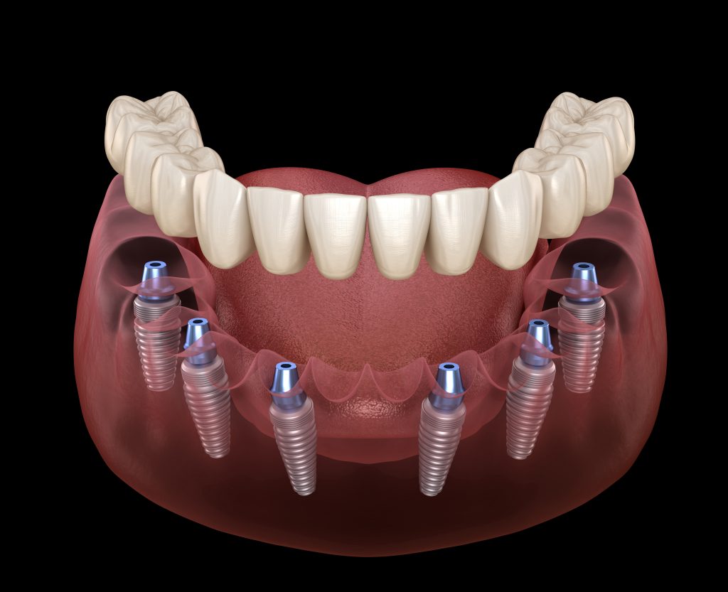 3D illustration of All-on-6 dental implants placed in the lower jaw to support a full fixed prosthetic arch