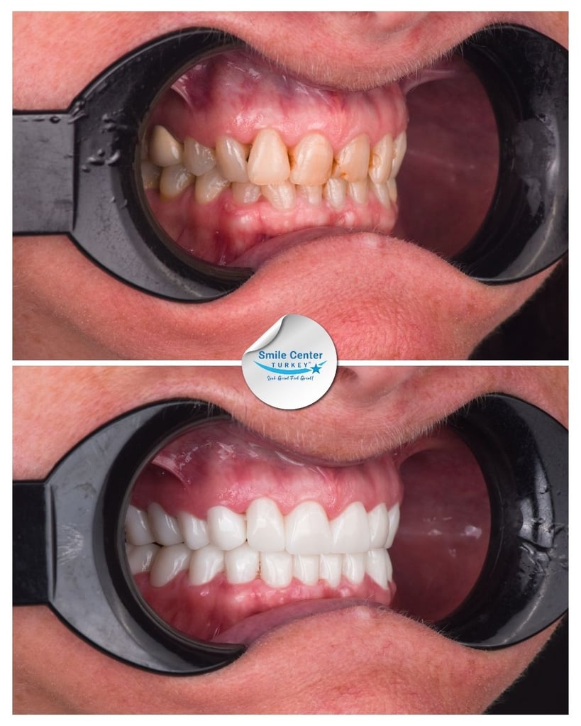 Side view before and after of a male patient’s teeth with moustache, showing severely decayed, crooked teeth before treatment and bright, straight white teeth after dental restoration at Smile Center Turkey.