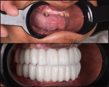 Dental tourism in Turkey with implants for diabetics