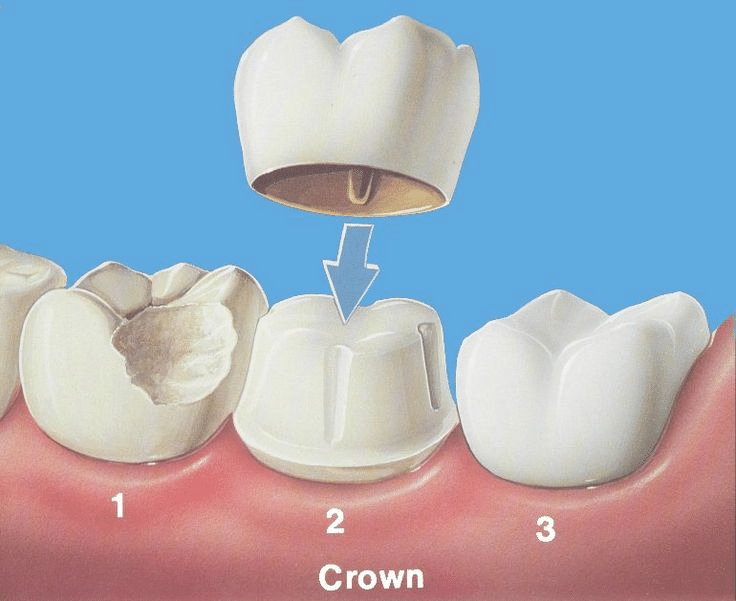 Dental crowns full tooth coverage Smile Center Turkey