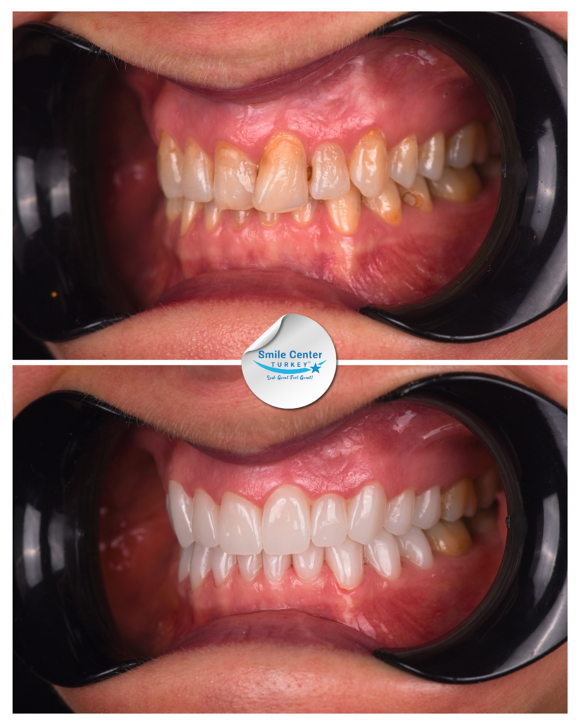 Smile Center Turkey veneers results — before and after
