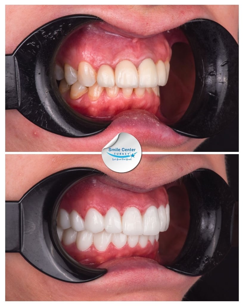 Side view of a patient's teeth using cheek retractors, showing yellowed, crowded teeth before treatment and even, white teeth after dental restoration at Smile Center Turkey.