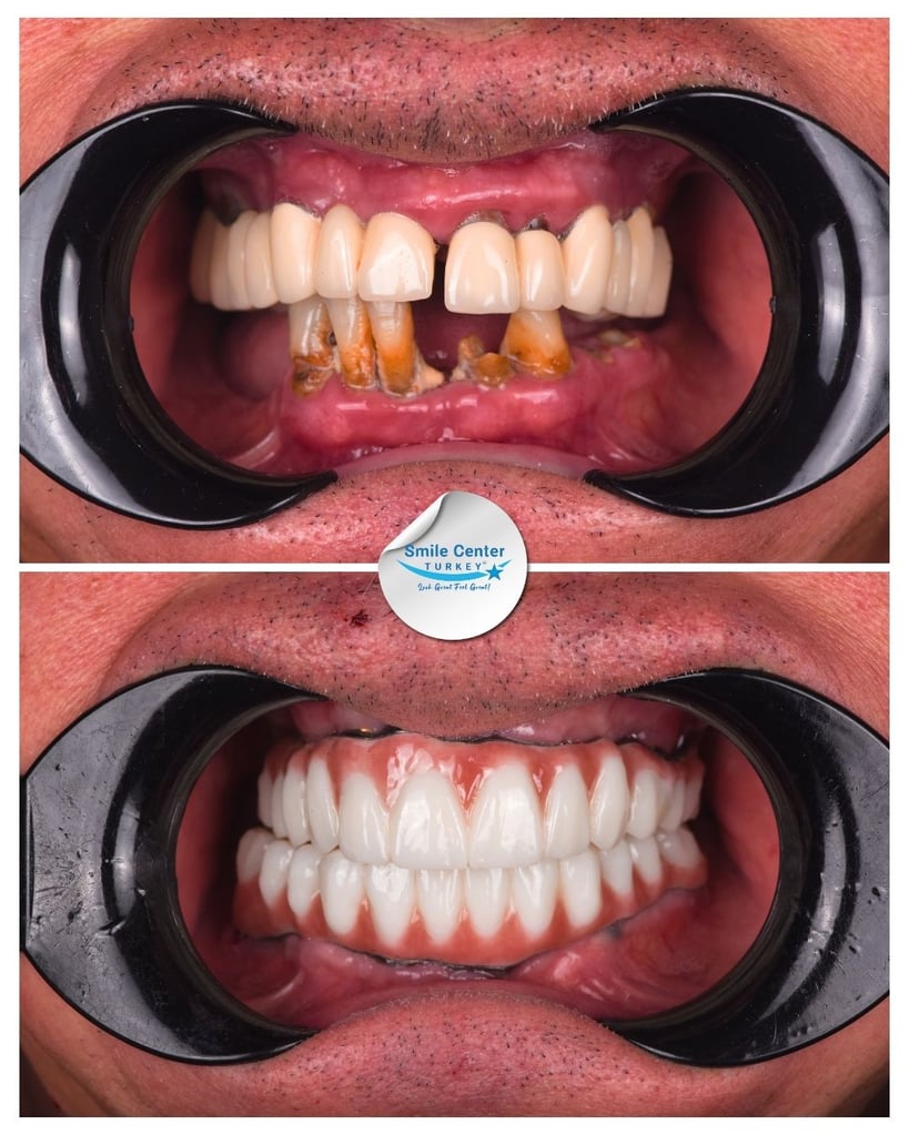 Close-up before and after front view of a patient’s mouth showing severely decayed and worn-down lower teeth before treatment and a full set of straight white teeth after dental restoration at Smile Center Turkey.