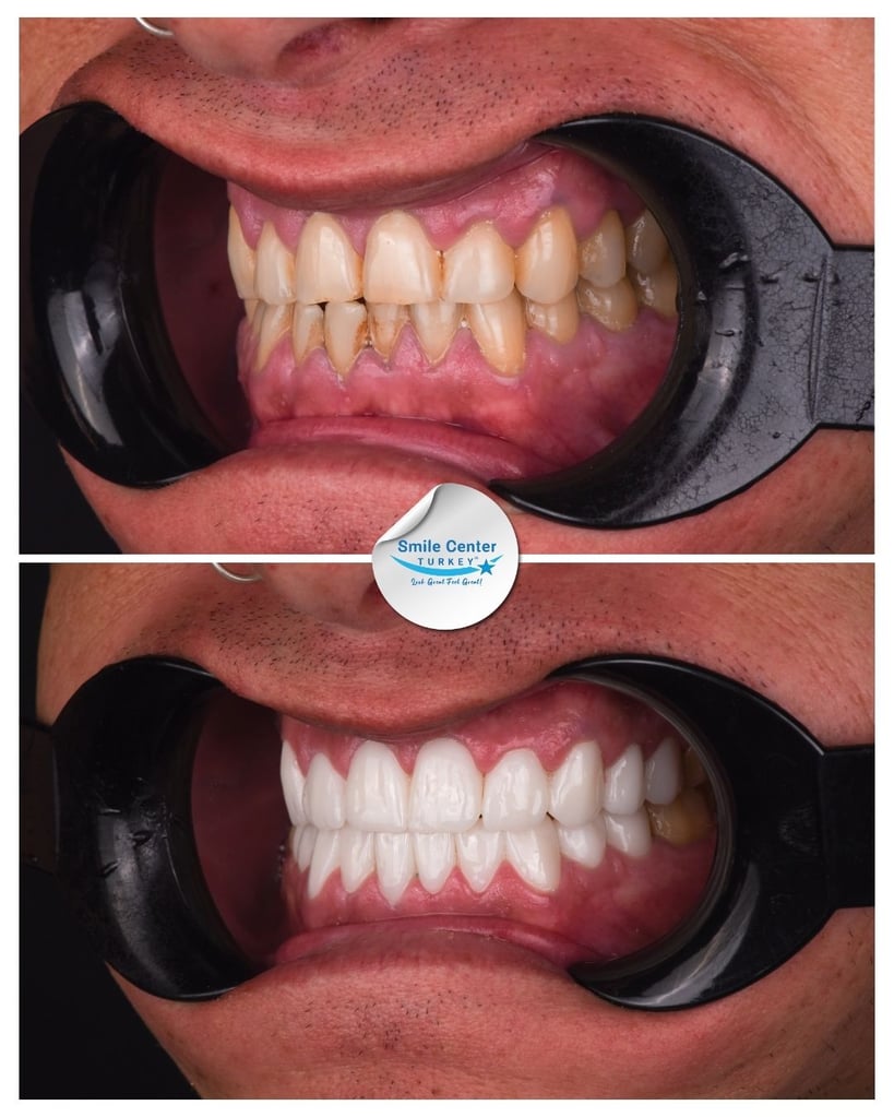Before-and-after side view of dental restoration at Smile Center Turkey.