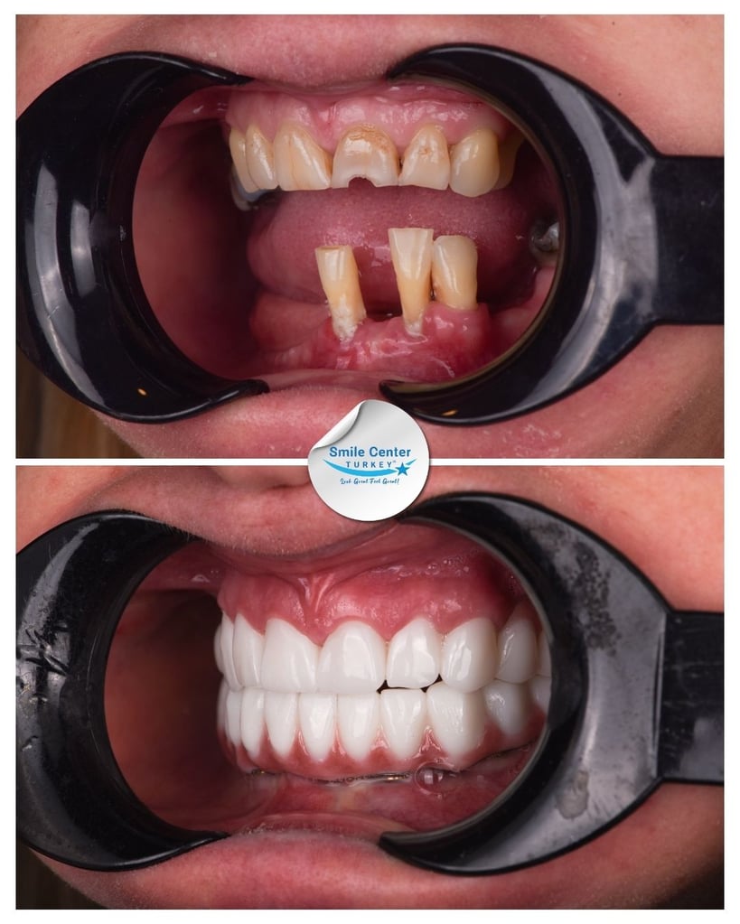 Close-up front view before and after of a patient’s mouth showing missing and decayed teeth before treatment and a complete set of straight white teeth after dental restoration at Smile Center Turkey.