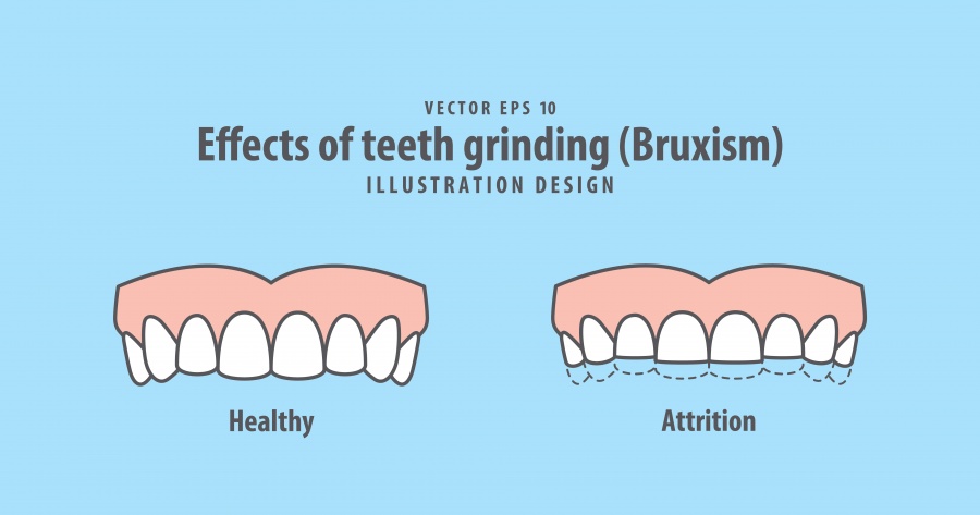 Bruxism (Teeth Grinding): A Growing Concern