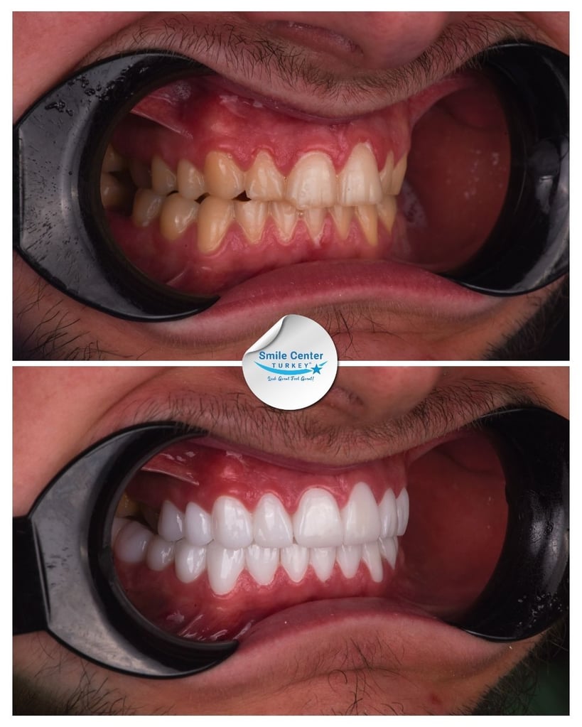 Before and after side view of a male patient’s teeth showing yellow, worn teeth before treatment and straight, white teeth after dental restoration at Smile Center Turkey.