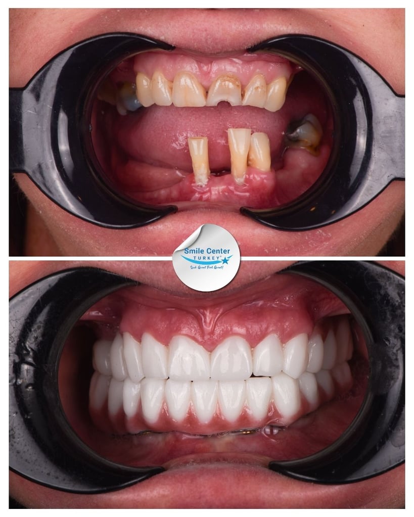 Before and after close-up front view of a patient’s mouth showing missing and decayed teeth with dental posts before treatment and a full set of white teeth after dental restoration at Smile Center Turkey.