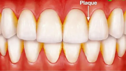 Plaque formation on teeth illustration