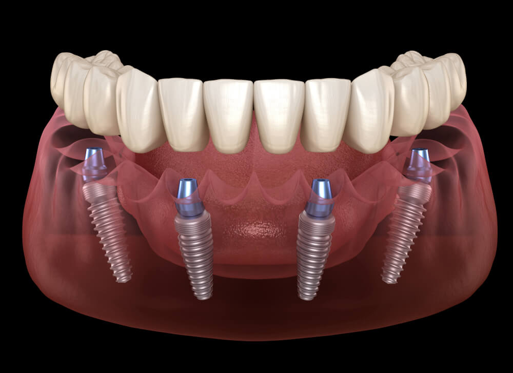 All-on-4 dental implant technique illustration – four implants supporting a full arch prosthesis