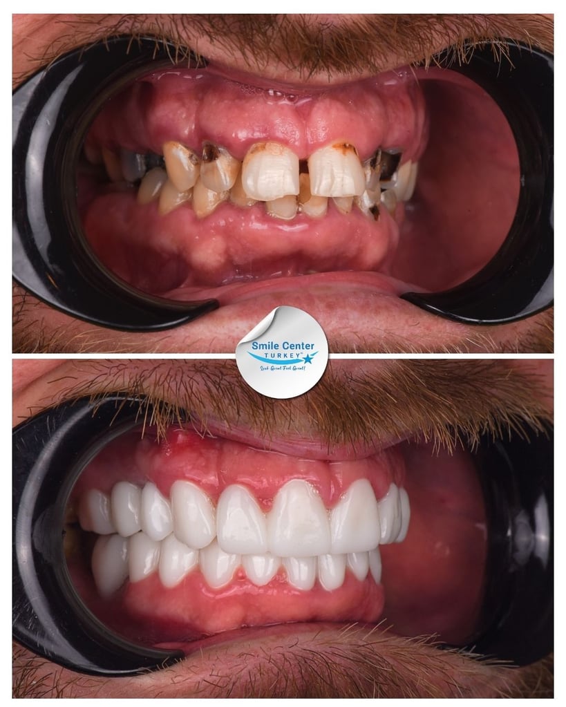 Anthony – Smile Center Turkey®