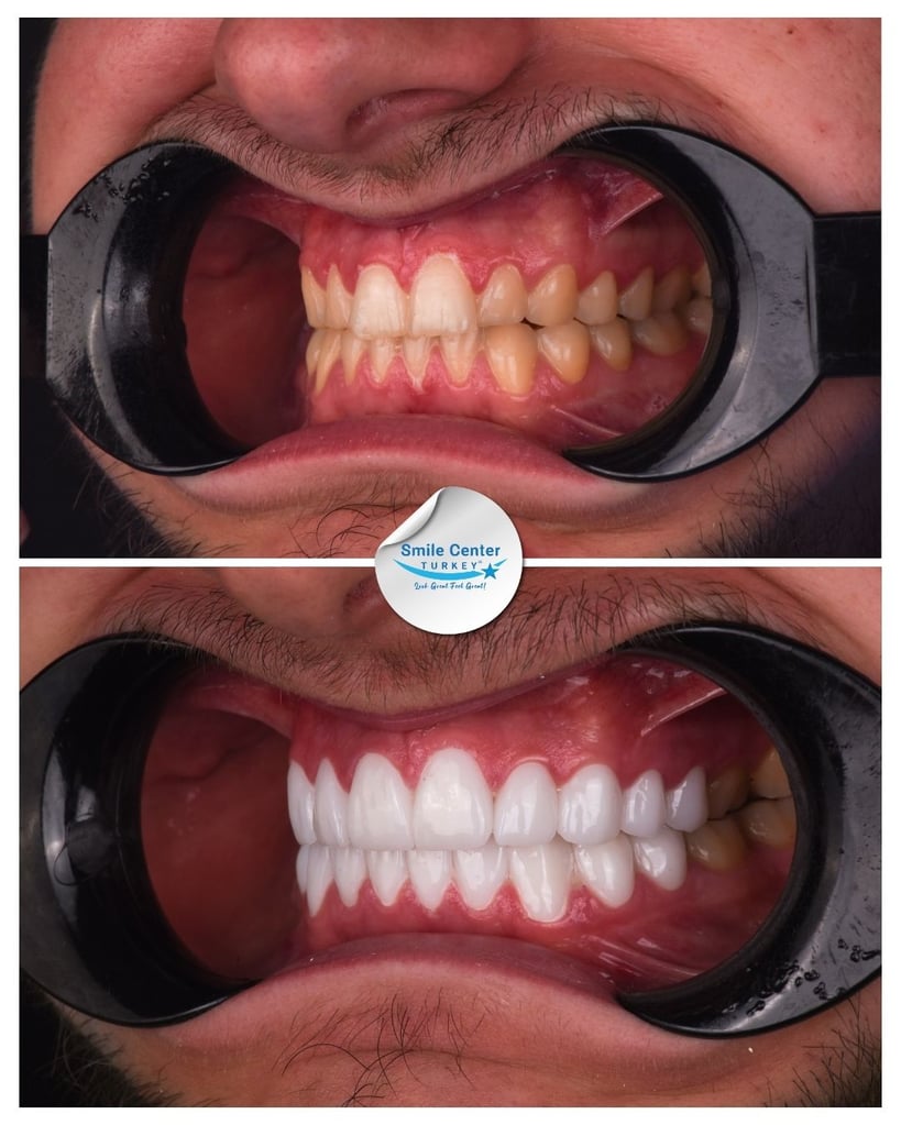 Before-and-after close-up of male patient’s teeth: top photo shows discolored, stained teeth; bottom photo shows bright white teeth after dental restoration at Smile Center Turkey.
