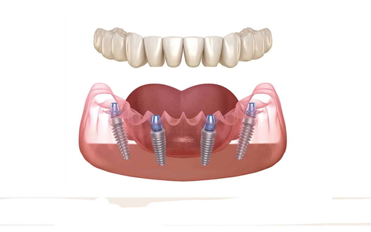 Before and after cosmetic surgery at Smile Center Turkey