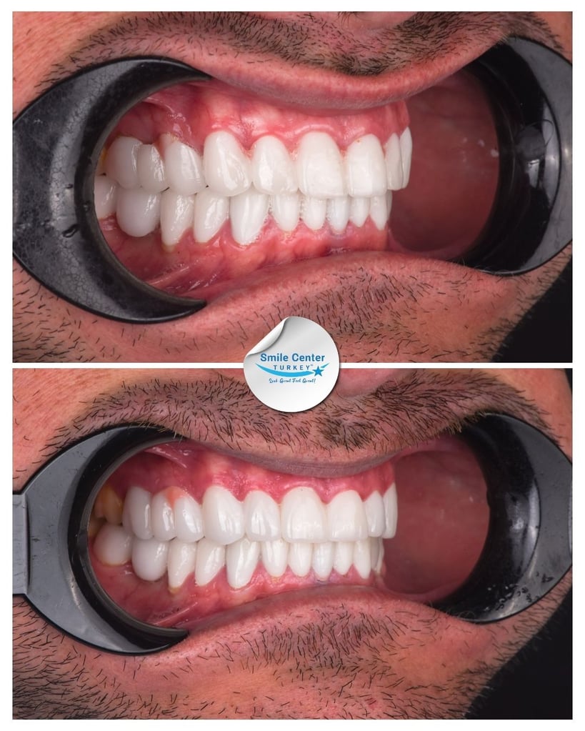 Side view of a male patient's teeth with moustache and cheek retractors showing straight white teeth after dental restoration at Smile Center Turkey.