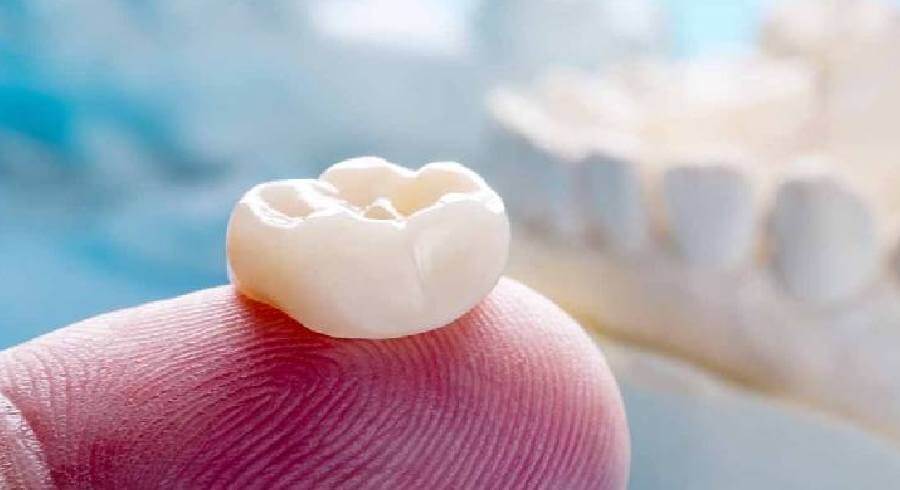 Dental implant stages: fixture, abutment and final crown at Smile Center Turkey