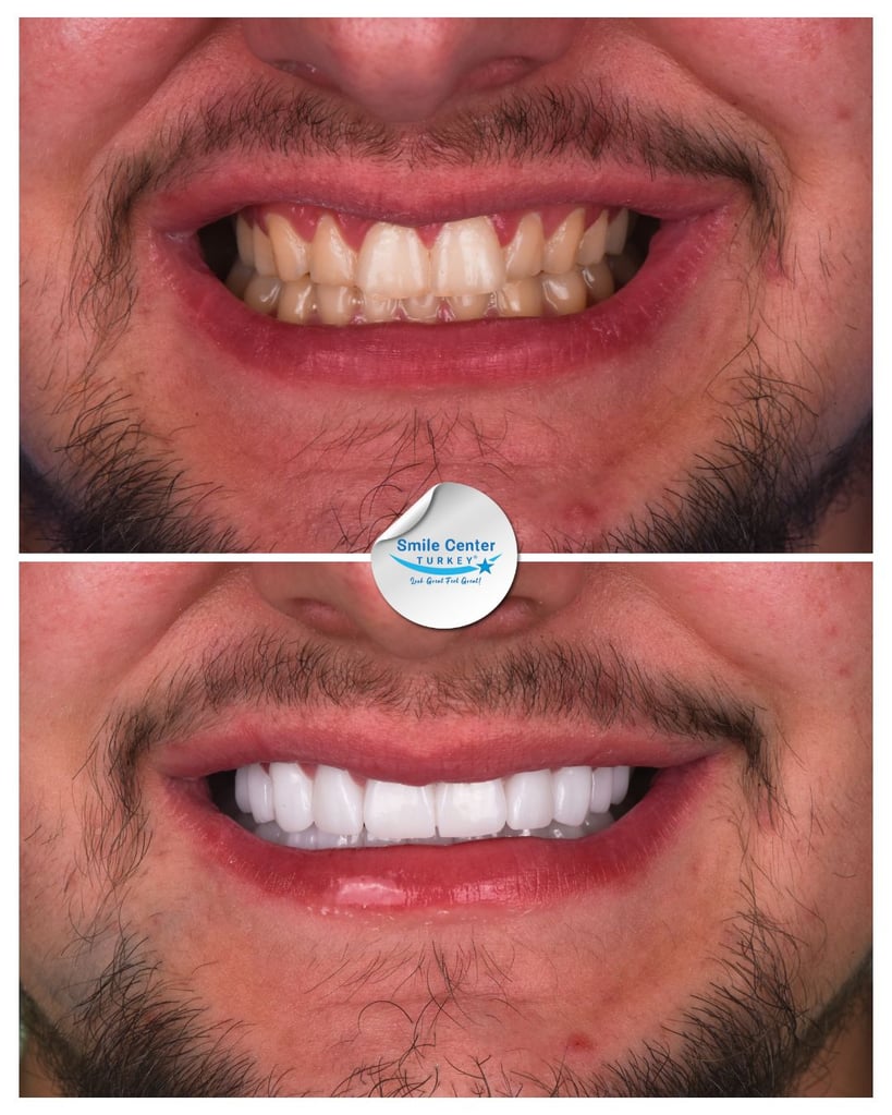 Before and after close-up of a young man’s smile showing yellow, chipped teeth before treatment and bright white teeth after dental restoration at Smile Center Turkey.