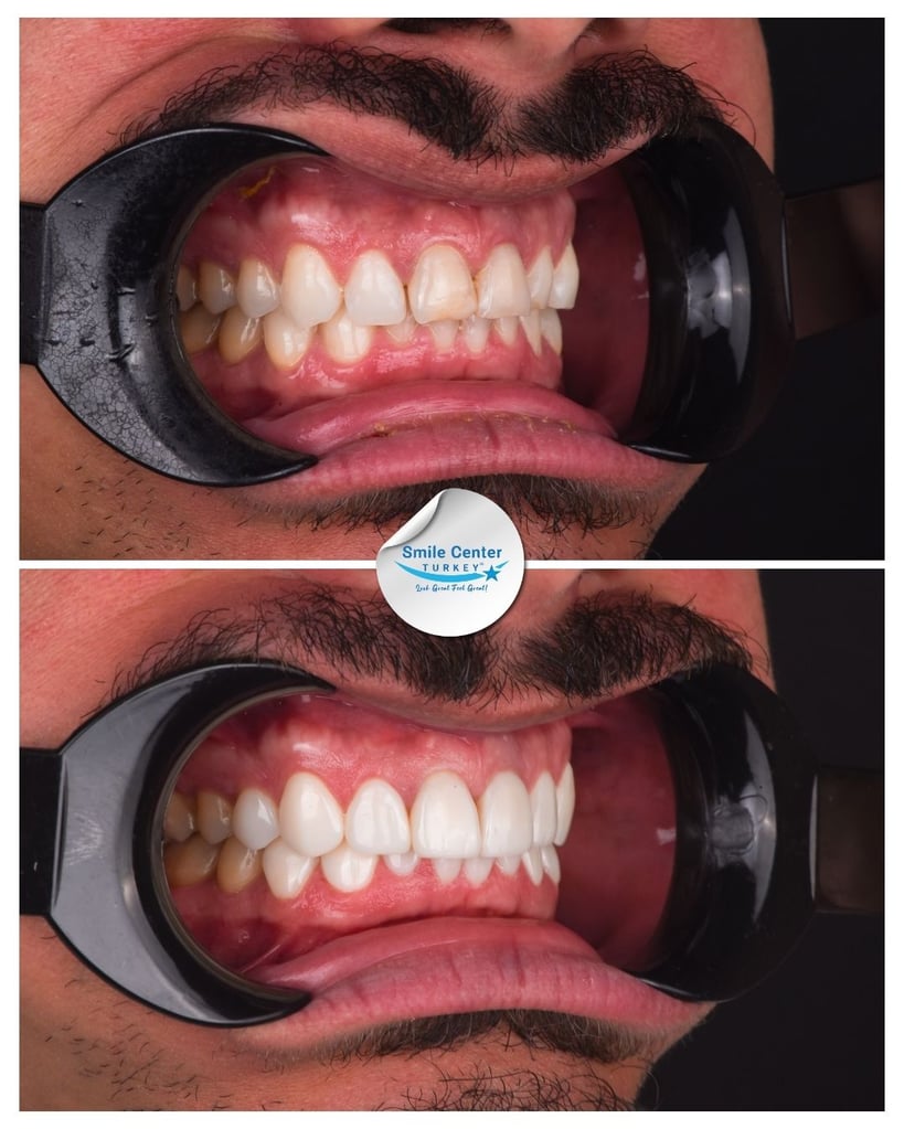 Before and after side view of a male patient's teeth with a moustache and cheek retractors, showing crooked and uneven teeth before treatment and straight, white teeth after dental restoration at Smile Center Turkey.