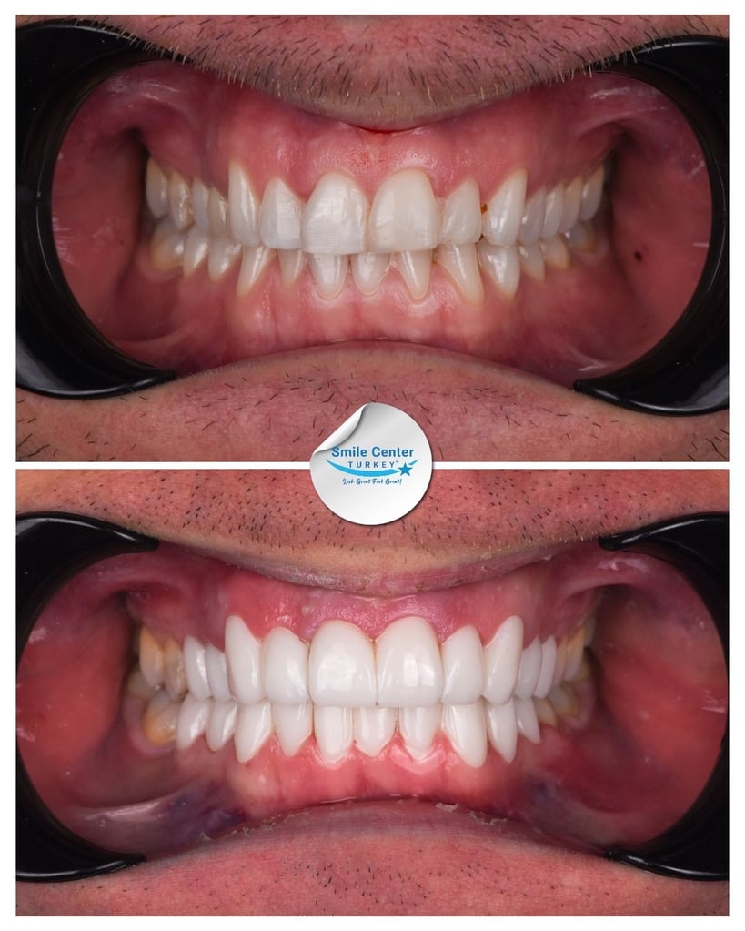Before and after front view of a male patient's teeth showing crooked, yellow teeth before treatment and straight white teeth after dental restoration at Smile Center Turkey.