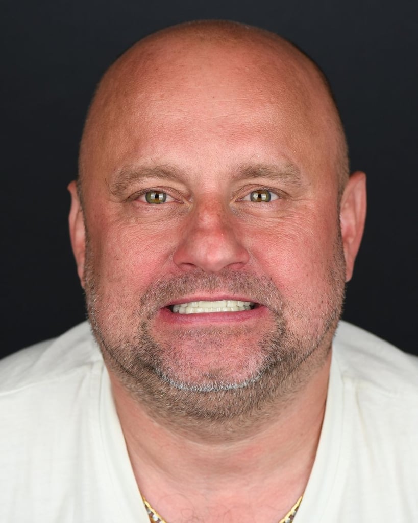 Portrait of a bald middle-aged man with a neatly trimmed beard, wearing a white T-shirt and gold necklace, smiling and showing bright white teeth against a dark background at Smile Center Turkey.