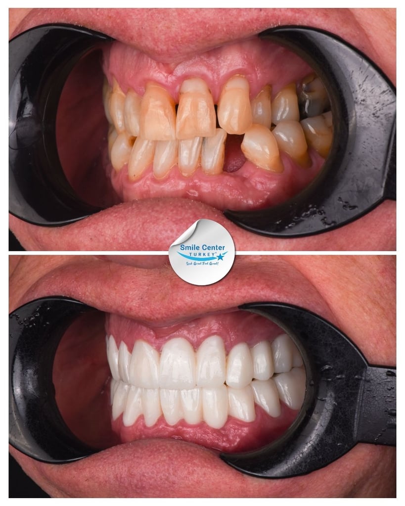 Before and after front view of a patient's teeth with cheek retractors, showing severe decay and missing teeth before treatment and a full set of white, straight teeth after dental restoration at Smile Center Turkey.