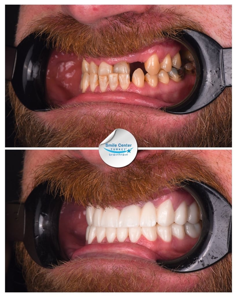 Before and after front view of a bearded male patient’s mouth showing misaligned yellow teeth before treatment and bright white teeth after dental restoration at Smile Center Turkey.