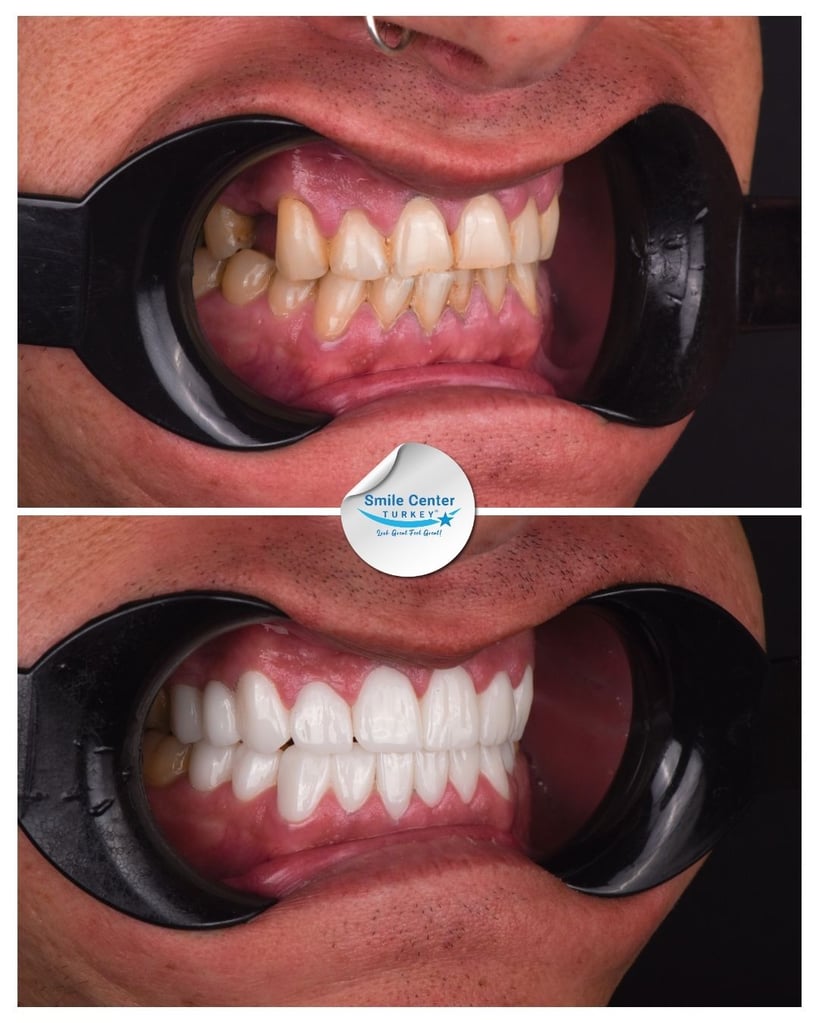 Side view before-and-after dental treatment showing teeth restoration at Smile Center Turkey.