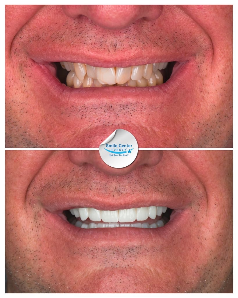 Before-and-after close-up of a male patient's smile with moustache, showing discolored and chipped teeth before treatment and straight, white teeth after dental restoration at Smile Center Turkey.