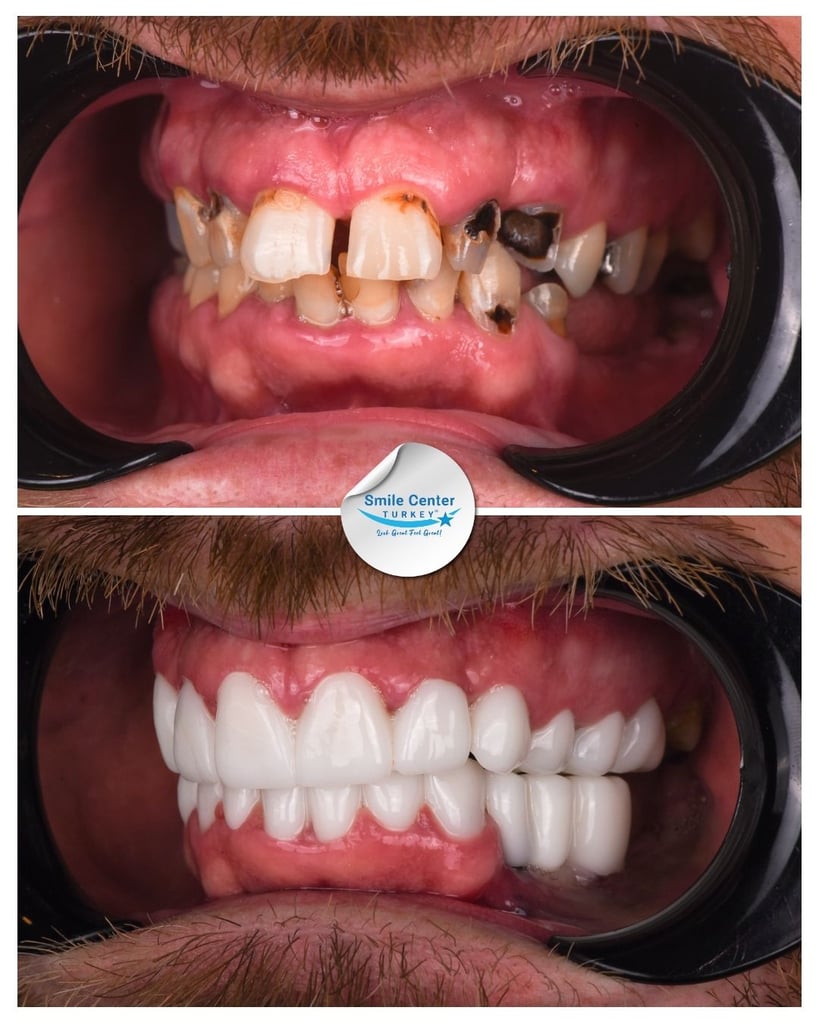 Anthony – Smile Center Turkey®