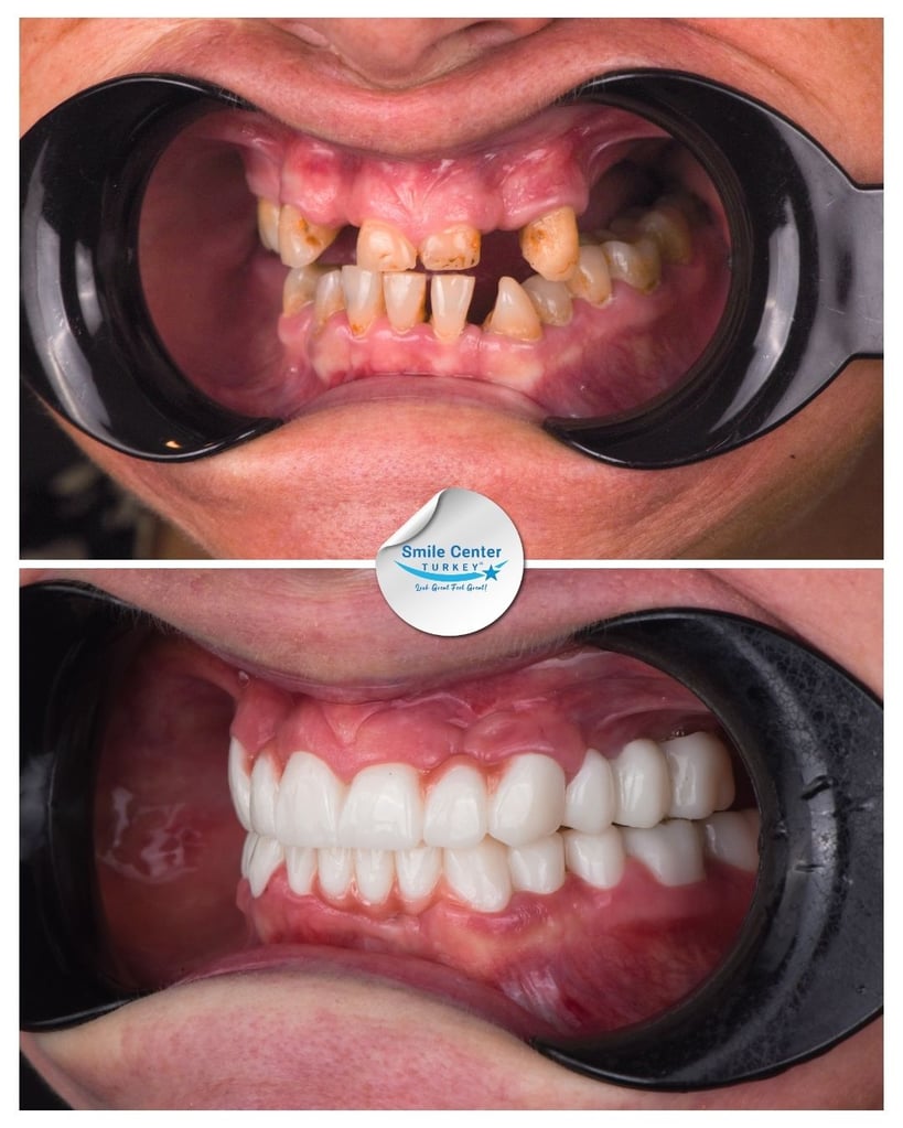 Before and after front view of a female patient's teeth with cheek retractors, showing extremely decayed and missing teeth before treatment and a full set of white, straight teeth after dental restoration at Smile Center Turkey.