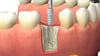 All-on-4 dental implants procedure explained at Smile Center Turkey