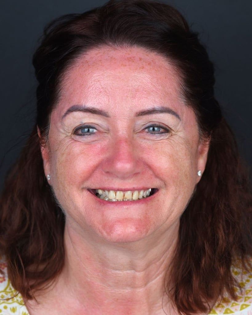 Portrait of a middle-aged woman with dark brown hair pulled back and freckles, smiling naturally with yellow, uneven teeth, wearing a yellow patterned top at Smile Center Turkey.