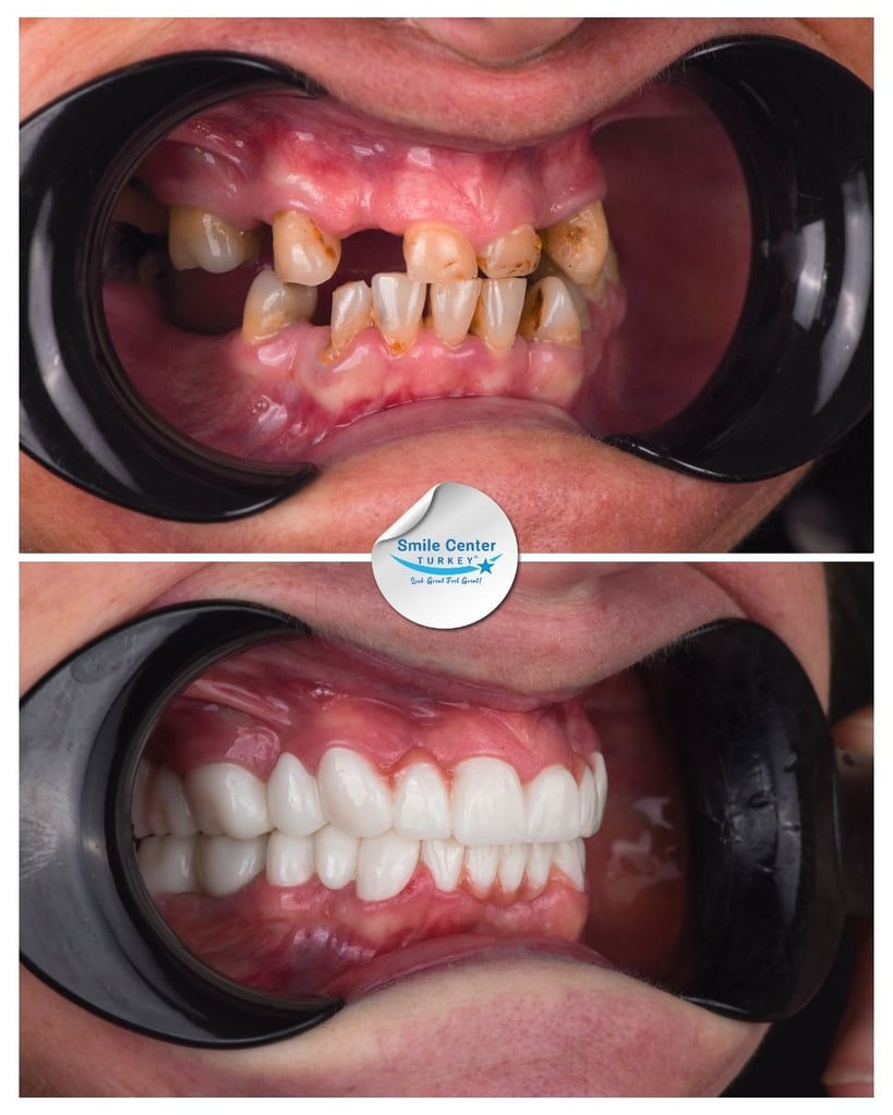 Before and after front view of a female patient's teeth with cheek retractors, showing severely decayed and broken teeth before treatment and white, aligned teeth after dental restoration at Smile Center Turkey.