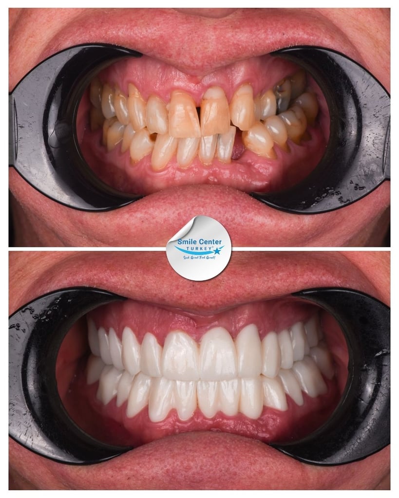 Before and after front view of a patient's teeth with cheek retractors, showing yellowed, chipped teeth before treatment and white, straight teeth after dental restoration at Smile Center Turkey.