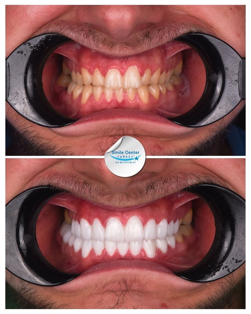 Before-and-after frontal view of dental restoration at Smile Center Turkey.
