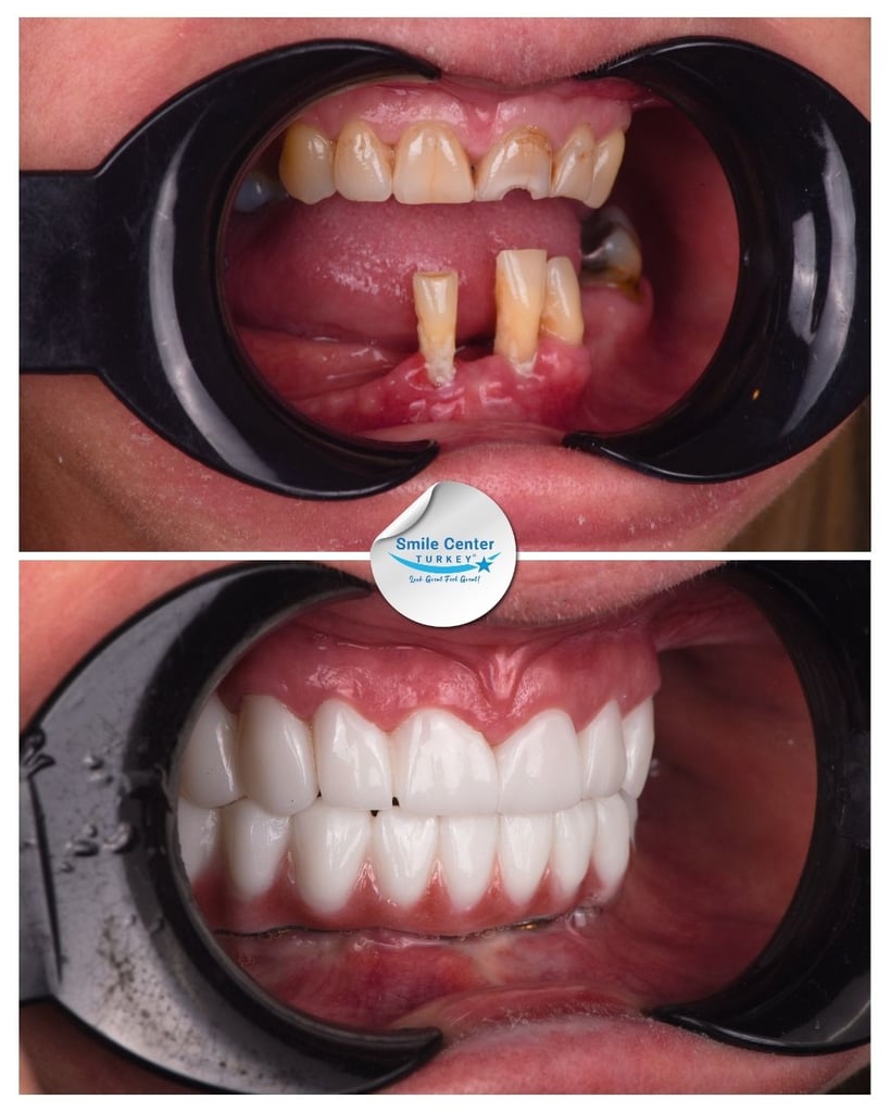 Close-up before and after front view of a patient’s mouth showing missing and decayed teeth before treatment and a full set of straight white teeth after dental restoration at Smile Center Turkey.