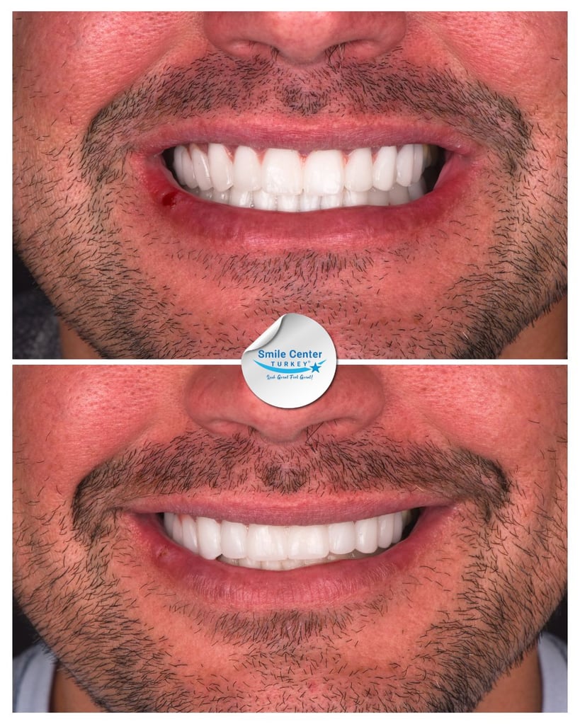 Close-up of a man's moustache and smile showing bright white teeth and healing gums after dental restoration at Smile Center Turkey.