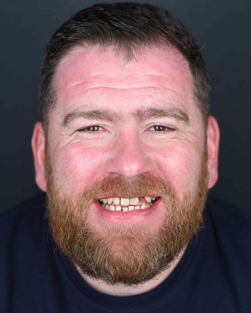 Portrait of a middle-aged man with short dark hair and a full beard wearing a black t-shirt, smiling to reveal yellow and missing upper teeth before dental treatment at Smile Center Turkey.