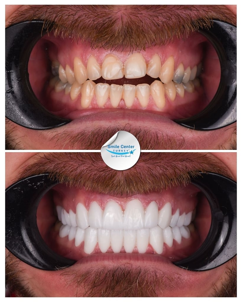 Before and after front view of a male patient's teeth with moustache and cheek retractors, showing yellowed, chipped teeth before treatment and white, straight teeth after dental restoration at Smile Center Turkey.