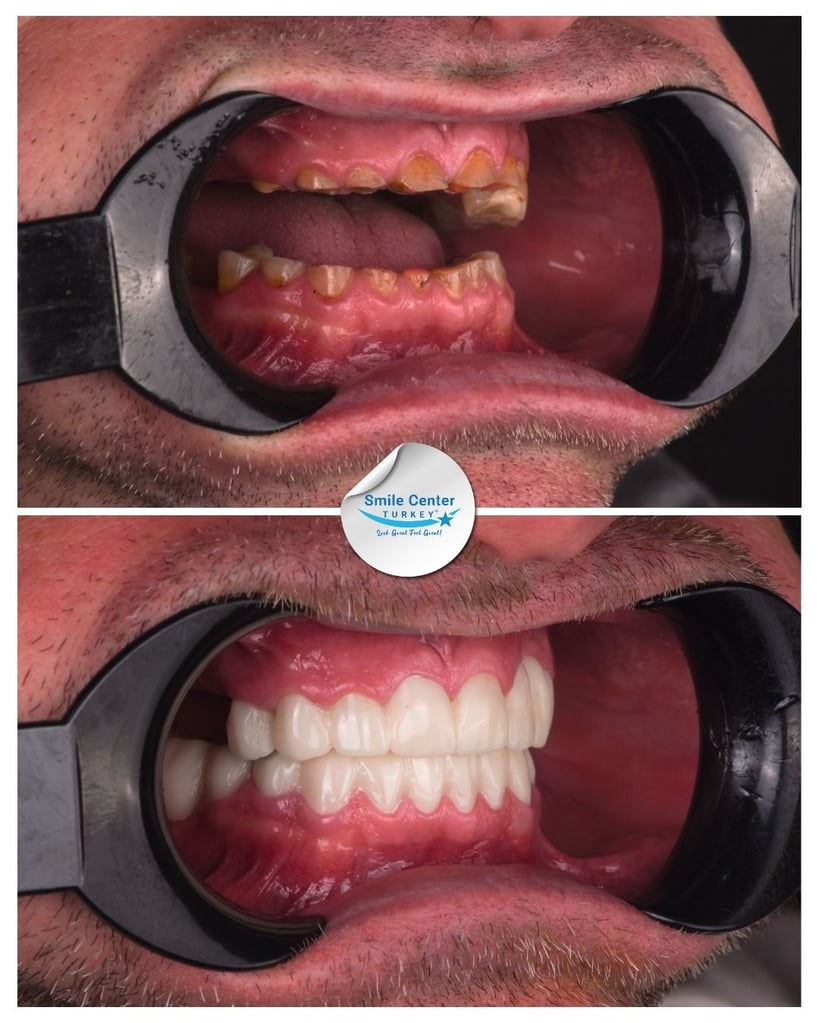 Before and after side view of a patient’s mouth showing broken, discoloured teeth before treatment and straight, white teeth after dental restoration at Smile Center Turkey.