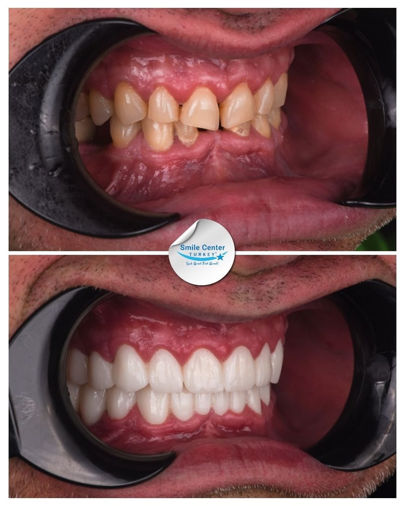 Before and after side view of a patient’s teeth showing yellow, crowded teeth before treatment and white, straight teeth after dental restoration at Smile Center Turkey.