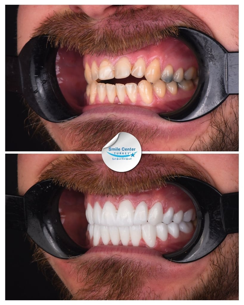 Before and after oblique view of a male patient's teeth with moustache and cheek retractors, showing heavily decayed, yellow teeth before treatment and white, straight teeth after dental restoration at Smile Center Turkey.