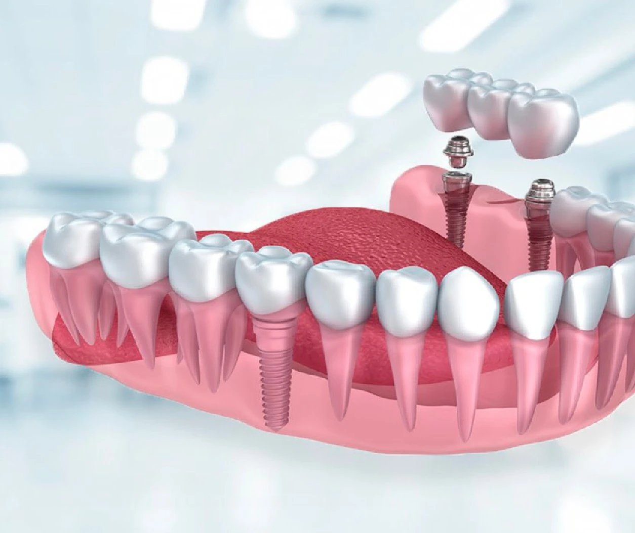 Before and after cosmetic surgery at Smile Center Turkey