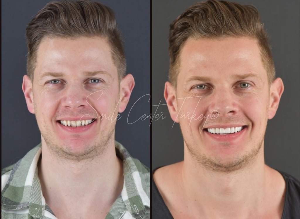 Before and after veneer treatment of a UK patient at Smile Center Turkey in Antalya — showing natural, aesthetic smile transformation with porcelain veneers (2025).