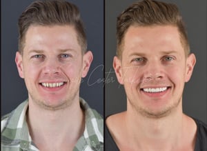Before and after veneer treatment of a UK patient at Smile Center Turkey in Antalya — showing natural, aesthetic smile transformation with porcelain veneers (2025).