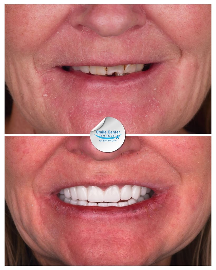 Before and after front view of a patient’s smile showing missing and severely decayed teeth before treatment and bright, straight white teeth after dental restoration at Smile Center Turkey.
