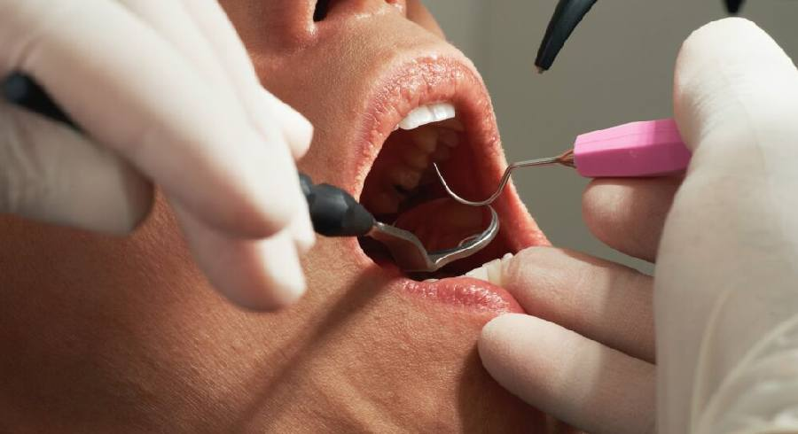 Illustration showing signs of failed root canal treatment