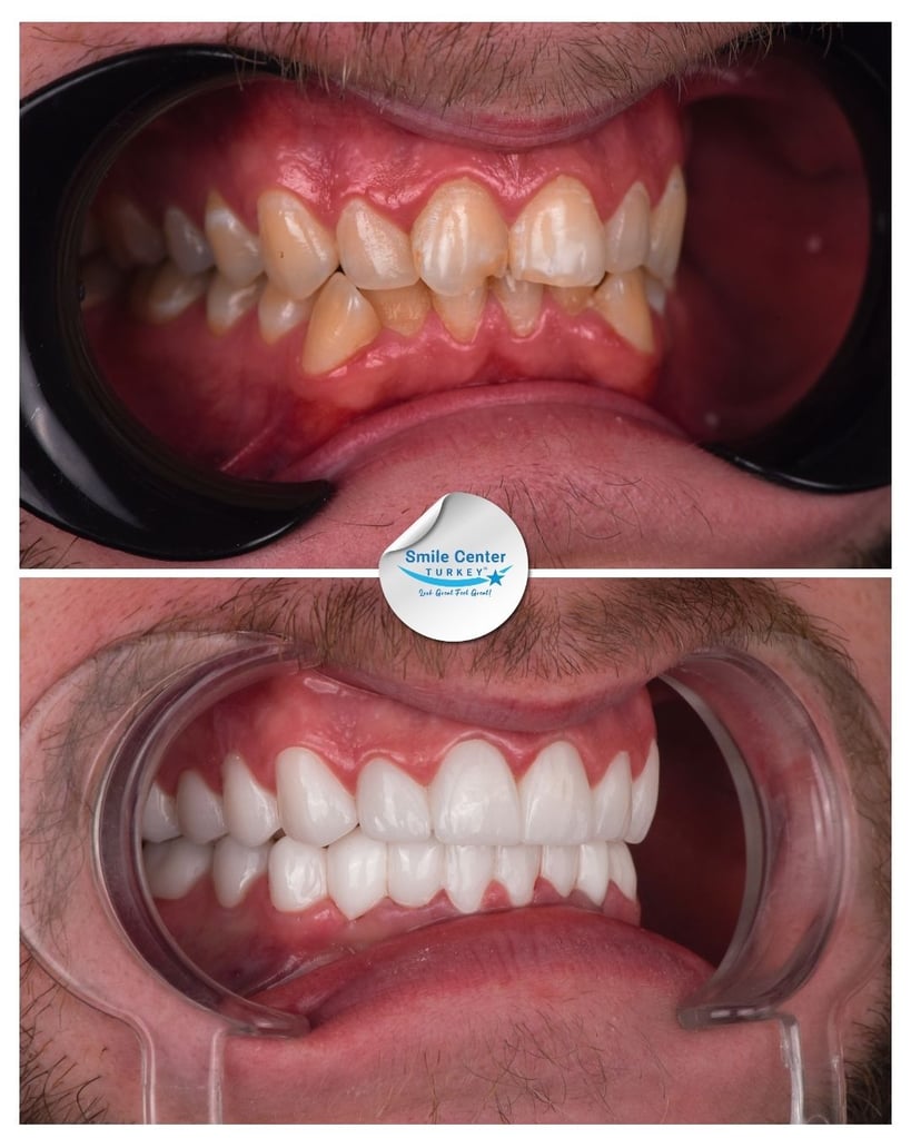 Before and after side view of a male patient's teeth with moustache showing severely misaligned, yellow teeth before treatment and straight white teeth after dental restoration at Smile Center Turkey.